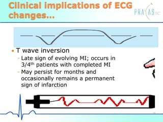 Clinical implications of ECG
changes…
 T wave inversion
◦ Late sign of evolving MI; occurs in
3/4th patients with completed MI
◦ May persist for months and
occasionally remains a permanent
sign of infarction
38
 