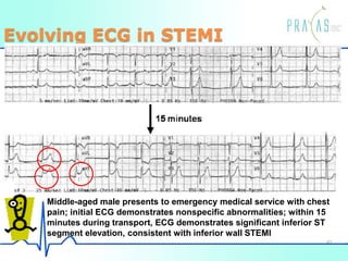 Evolving ECG in STEMI
Middle-aged male presents to emergency medical service with chest
pain; initial ECG demonstrates nonspecific abnormalities; within 15
minutes during transport, ECG demonstrates significant inferior ST
segment elevation, consistent with inferior wall STEMI
40
 