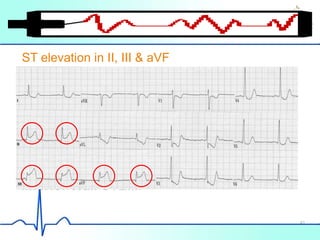 Inferior Wall STEMI
ST elevation in II, III & aVF
41
 