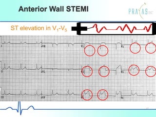 Anterior Wall STEMI
ST elevation in V1-V5
42
 