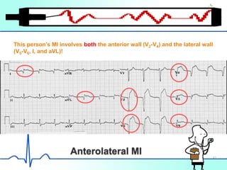 Anterolateral MI
This person’s MI involves both the anterior wall (V2-V4) and the lateral wall
(V5-V6, I, and aVL)!
43
 