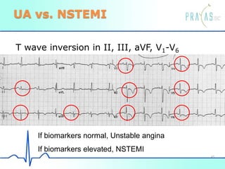 UA vs. NSTEMI
T wave inversion in II, III, aVF, V1-V6
If biomarkers normal, Unstable angina
If biomarkers elevated, NSTEMI
45
 