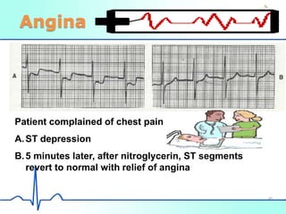 Angina
Patient complained of chest pain
A.ST depression
B.5 minutes later, after nitroglycerin, ST segments
revert to normal with relief of angina
46
 