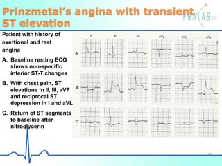 Prinzmetal’s angina with transient
ST elevation
Patient with history of
exertional and rest
angina
A. Baseline resting ECG
shows non-specific
inferior ST-T changes
B. With chest pain, ST
elevations in II, III, aVF
and reciprocal ST
depression in I and aVL
C. Return of ST segments
to baseline after
nitroglycerin
47
 