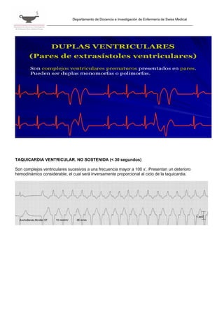 Departamento de Docencia e Investigación de Enfermería de Swiss Medical




                   DUPLAS VENTRICULARES
       (Pares de extrasístoles ventriculares)
        Son complejos ventriculares prematuros presentados en pares.
        Pueden ser duplas monomorfas o polimorfas.




TAQUICARDIA VENTRICULAR. NO SOSTENIDA (< 30 segundos)

Son complejos ventriculares sucesivos a una frecuencia mayor a 100 x’. Presentan un deterioro
hemodinámico considerable, el cual será inversamente proporcional al ciclo de la taquicardia.
 
