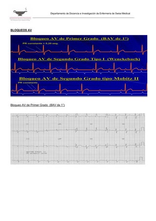 Departamento de Docencia e Investigación de Enfermería de Swiss Medical




BLOQUEOS AV

             Bloqueo AV de Primer Grado (BAV de 1°)
                                                1°
        PR constante > 0,20 seg.




     Bloqueo AV de Segundo Grado Tipo I (Wenckebach)




     Bloqueo AV de Segundo Grado tipo Mobitz II
     PR constante




Bloqueo AV de Primer Grado (BAV de 1°)
 