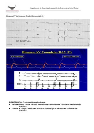 Departamento de Docencia e Investigación de Enfermería de Swiss Medical




Bloqueo AV de Segundo Grado (Secuencia 2:1)




                  Bloqueo AV Completo (BAV 3°)
     P-P constante                                                           Ritmo de ESCAPE




   BIBLIOGRAFIA: Presentación realizada por:
   • Laura Romano Fariña. Técnica en Prácticas Cardiológicas Técnica en Estimulación
             Cardíaca
   • Damián A. Longo. Técnico en Prácticas Cardiológicas Técnico en Estimulación
             Cardíaca
 