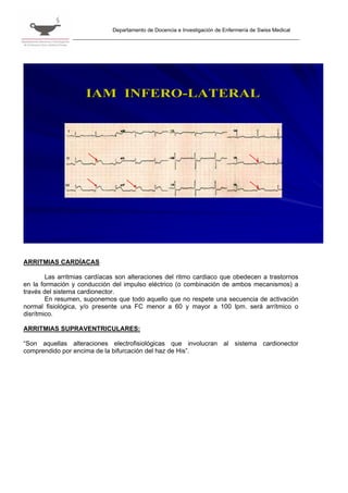 Departamento de Docencia e Investigación de Enfermería de Swiss Medical




                     IAM INFERO-LATERAL




ARRITMIAS CARDÍACAS

        Las arritmias cardíacas son alteraciones del ritmo cardiaco que obedecen a trastornos
en la formación y conducción del impulso eléctrico (o combinación de ambos mecanismos) a
través del sistema cardionector.
        En resumen, suponemos que todo aquello que no respete una secuencia de activación
normal fisiológica, y/o presente una FC menor a 60 y mayor a 100 lpm. será arrítmico o
disrítmico.

ARRITMIAS SUPRAVENTRICULARES:

“Son aquellas alteraciones electrofisiológicas que involucran al sistema cardionector
comprendido por encima de la bifurcación del haz de His”.
 