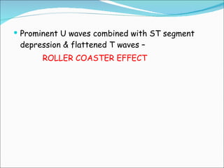 Prominent U waves combined with ST segment depression & flattened T waves –  ROLLER COASTER EFFECT 