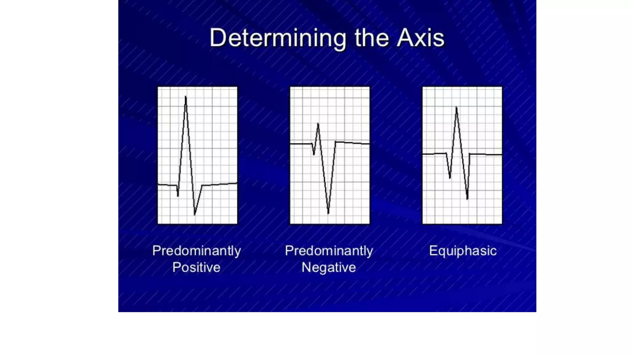 ECG-REVISION.pptx | Heart and Cardiovascular Diseases | Diseases and ...