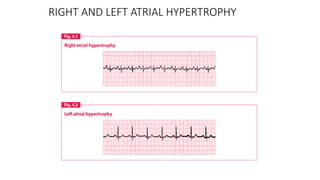 RIGHT AND LEFT ATRIAL HYPERTROPHY
 
