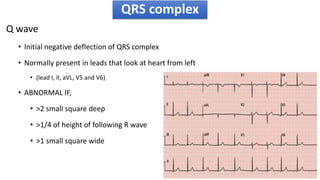 Downward Deflection Ecg made easy | PPTX