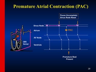 ECG-Slide-Set.pptx the basics of ECG reading | PPTX