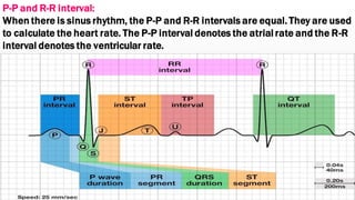 What Is Rp Interval Basics of electrocardiogram | PDF