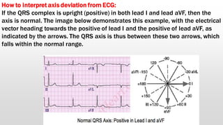 Basics of electrocardiogram | PDF