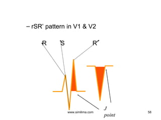 Ecg the basics ppt Cardiovascular Disorder PPT ecg-the-basics-ppt-cardiovascular-disorder-ppt