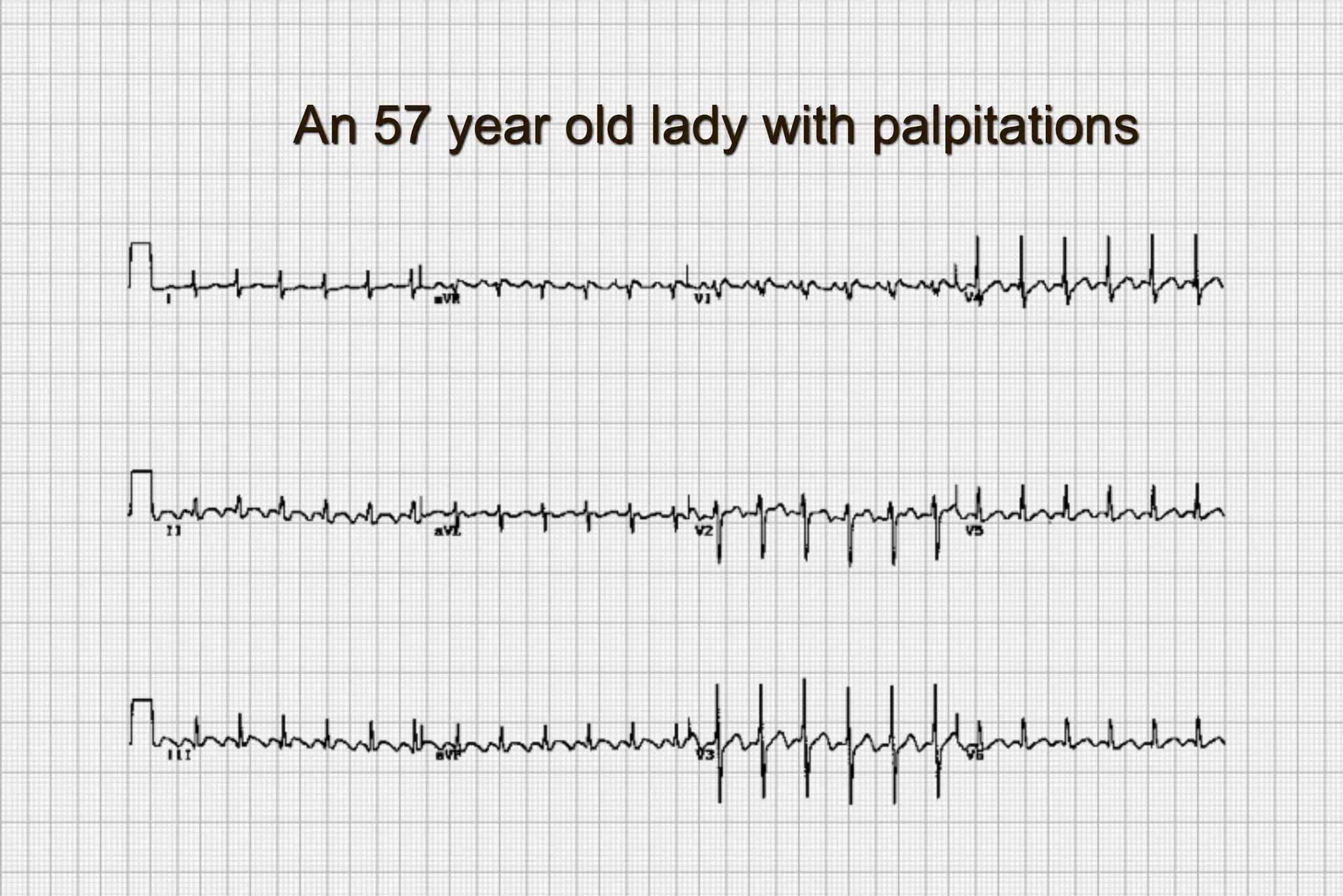 رسم قلب يوضح خفقان/تسرع قد يشعر به المريض