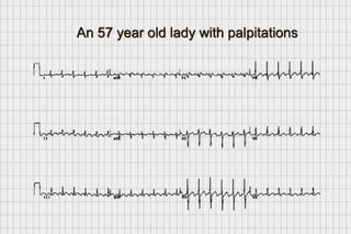 ECG workbook | PDF