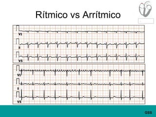 Rítmico vs Arrítmico