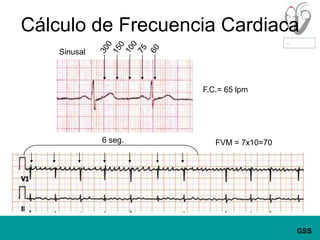 Cálculo de Frecuencia Cardiaca1003001507560SinusalF.C.= 65 lpm6 seg.FVM = 7x10=70