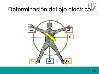 Determinación del eje eléctrico