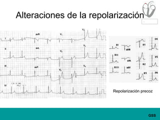 Alteraciones de la repolarizaciónRepolarización precoz