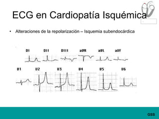 ECG en Cardiopatía IsquémicaAlteraciones de la repolarización – Isquemia subendocárdica