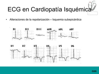 ECG en Cardiopatía IsquémicaAlteraciones de la repolarización – Isquemia subepicárdica