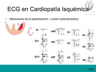 ECG en Cardiopatía IsquémicaAlteraciones de la repolarización – Lesión subendocárdica