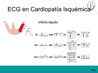 ECG en Cardiopatía IsquémicaInfarto Agudo