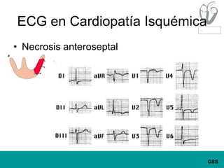 ECG en Cardiopatía IsquémicaNecrosis anteroseptal