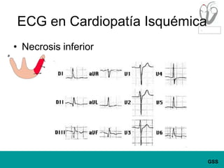 ECG en Cardiopatía IsquémicaNecrosis inferior