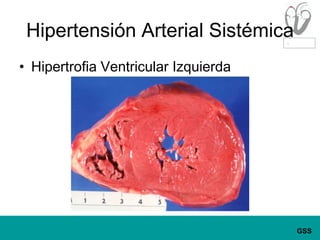 Hipertensión Arterial SistémicaHipertrofia Ventricular Izquierda