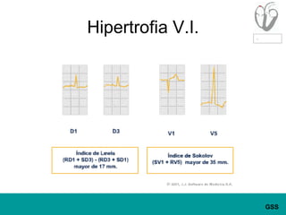 Hipertrofia V.I.