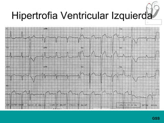 Hipertrofia Ventricular Izquierda