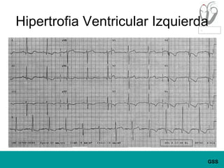 Hipertrofia Ventricular Izquierda
