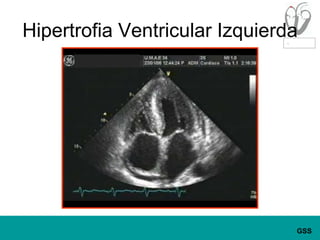 Hipertrofia Ventricular Izquierda