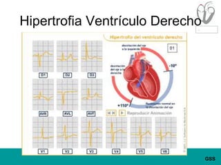 Hipertrofia Ventrículo Derecho