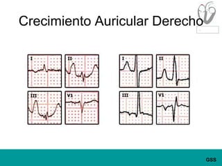 Crecimiento Auricular Derecho