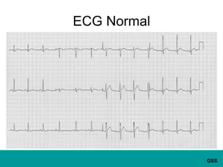 ECG Normal