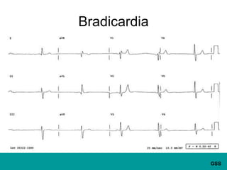 Bradicardia