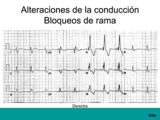 Alteraciones de la conducciónBloqueos de ramaDerecha