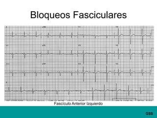 Bloqueos FascicularesFascículo Anterior Izquierdo