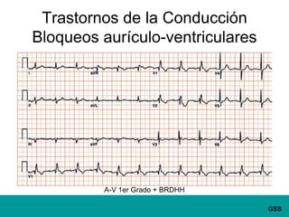 Trastornos de la ConducciónBloqueos aurículo-ventricularesA-V 1er Grado + BRDHH