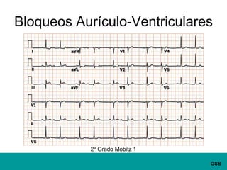 Bloqueos Aurículo-Ventriculares2º Grado Mobitz 1
