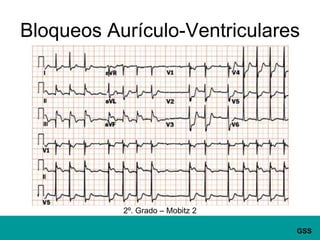 Bloqueos Aurículo-Ventriculares2º. Grado – Mobitz 2