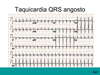 Taquicardia QRS angosto