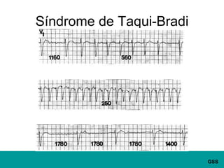 Síndrome de Taqui-Bradi