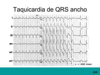 Taquicardia de QRS ancho