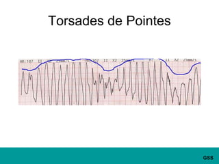 Torsades de Pointes